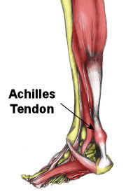 Achellis tendinopathy